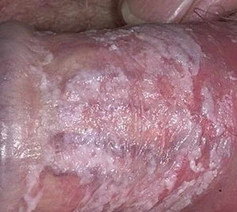 erutudes kalgendatud eritis