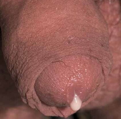 patoloogiline eritis erutuse korral